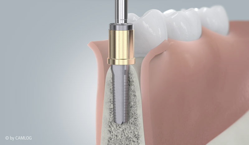 Implantation