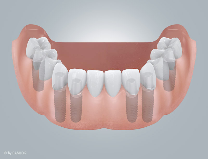 Festsitzender Implantatersatz
