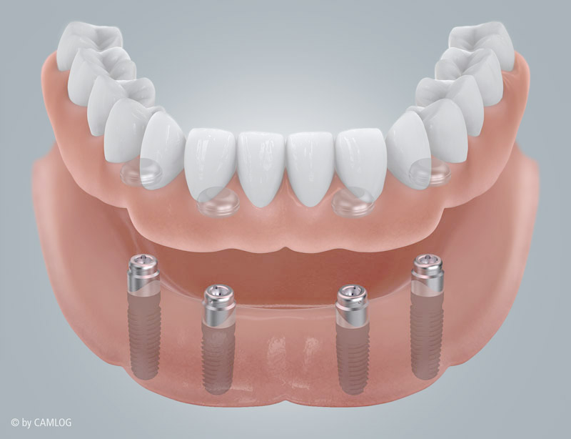 Locator-Implantatprothese